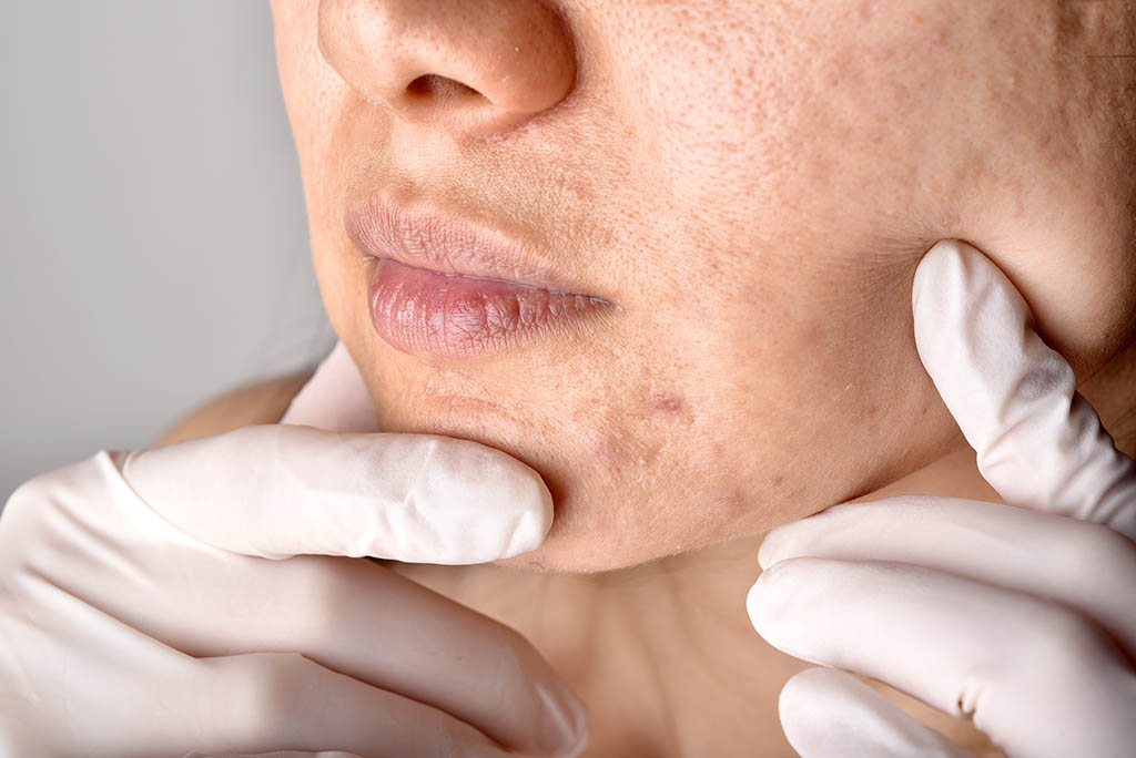 Acne scars How do you treat them? Arium Clinic Medical Aesthetics