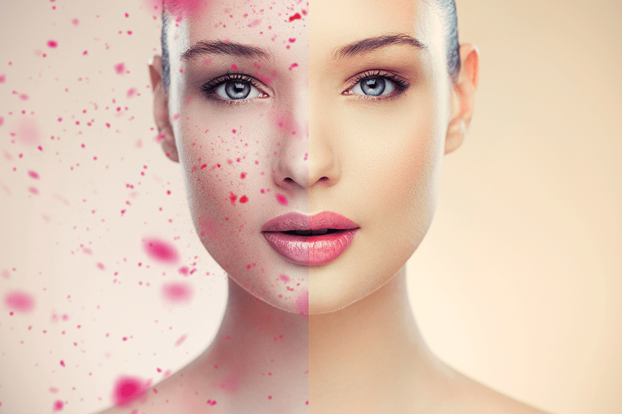 Flushed skin , pustules and papules may mean rosacea Arkana EN