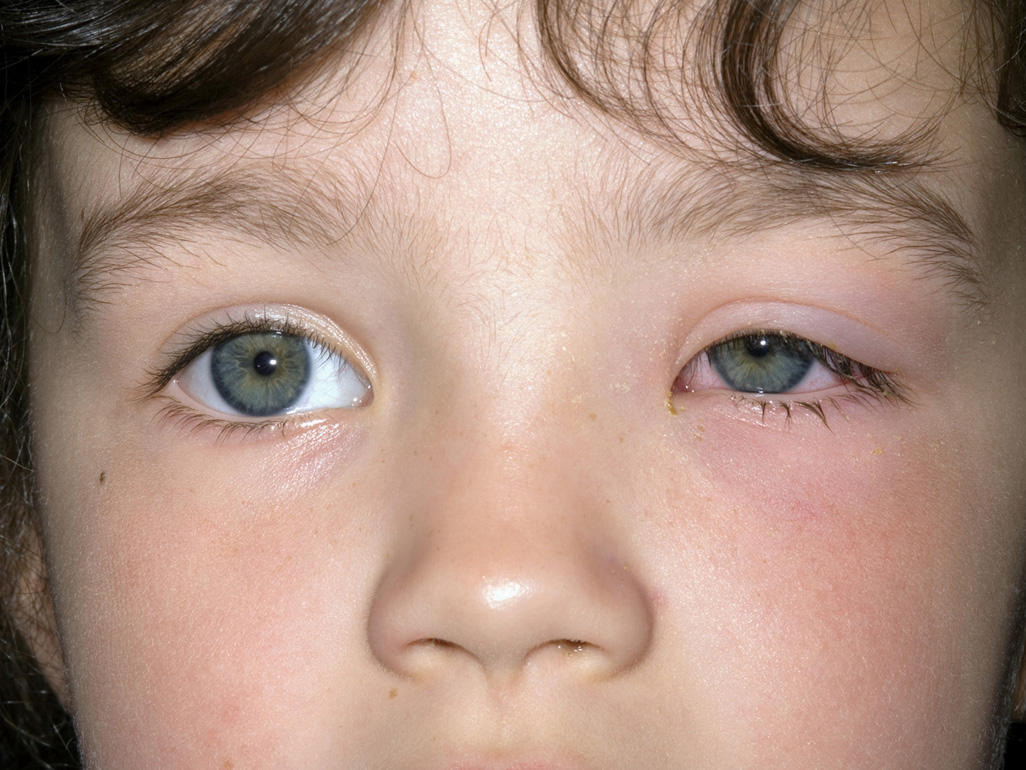 Conjunctivitis in children Armada Hospital JLT Dubai