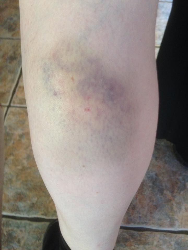 Woman shows injuries sustained in dog attack in Bessbrook Armagh I