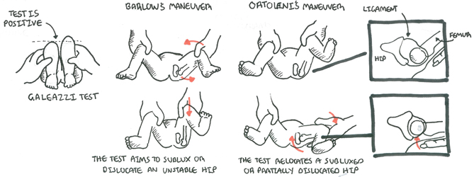 Developmental Hip Dysplasia Armando Hasudungan