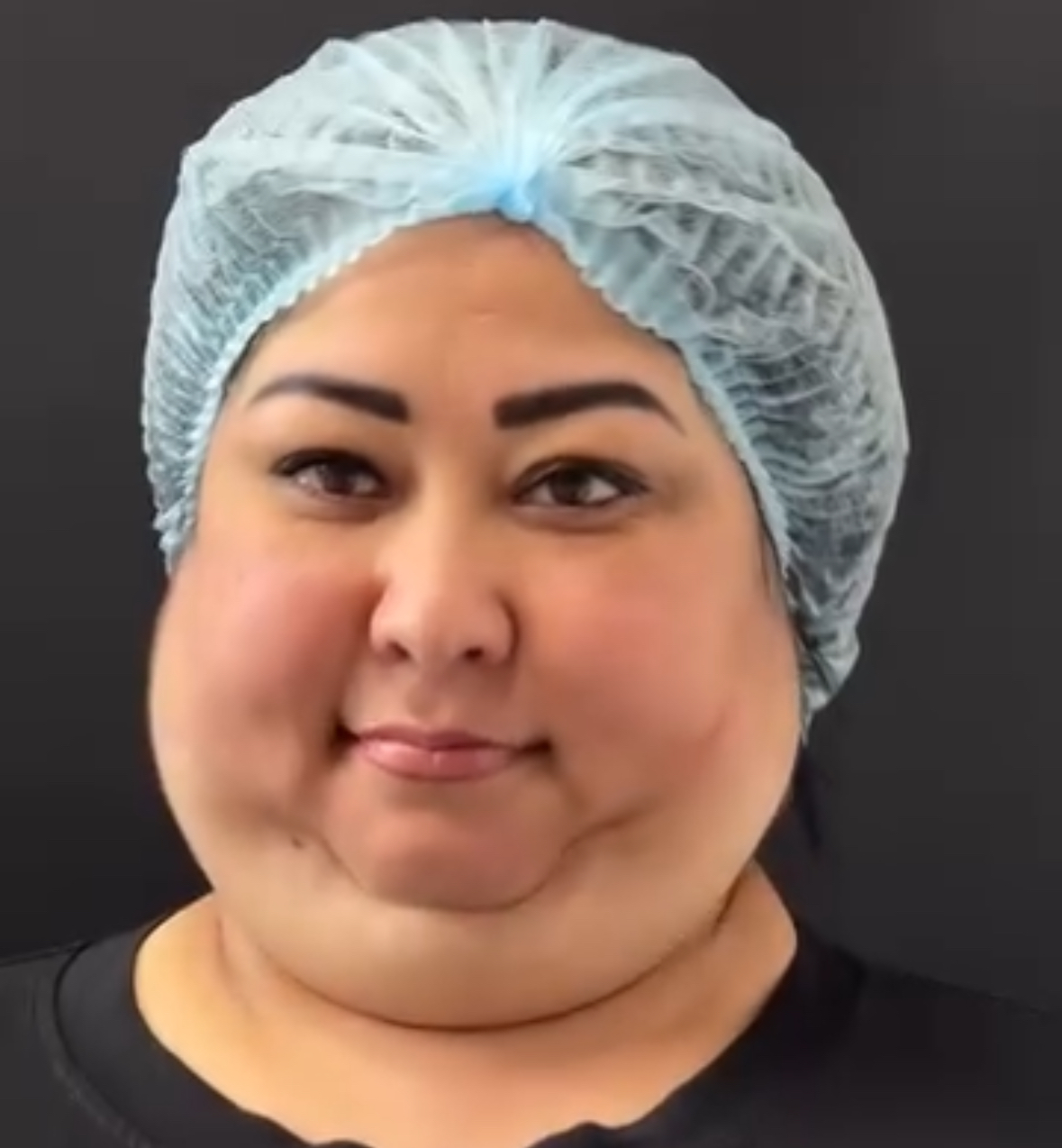 Just look at how this woman transformed after the surgery… you won’t