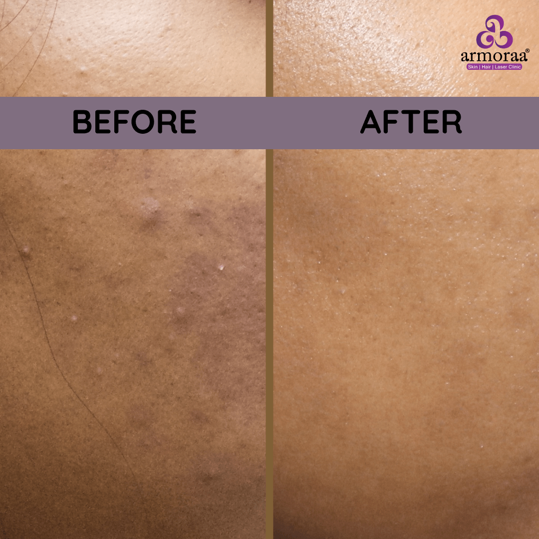 Melasma Treatments in Chennai Armoraa Clinic
