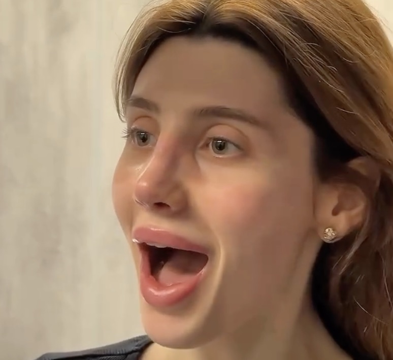 This Young Lady Got Surgery on Her Nose And The Transformation Will