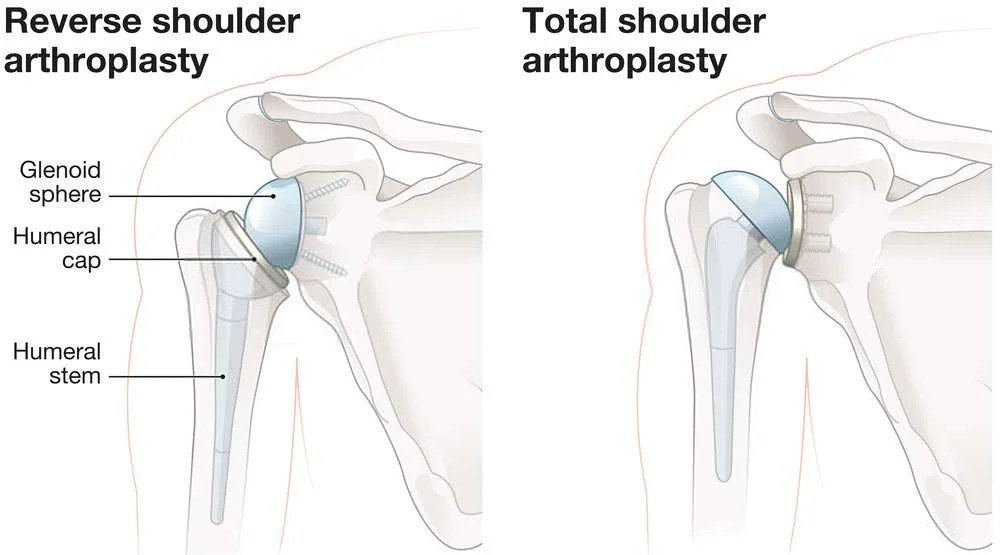 Shoulder Replacement Surgery in Thane Dr Bakul Arora