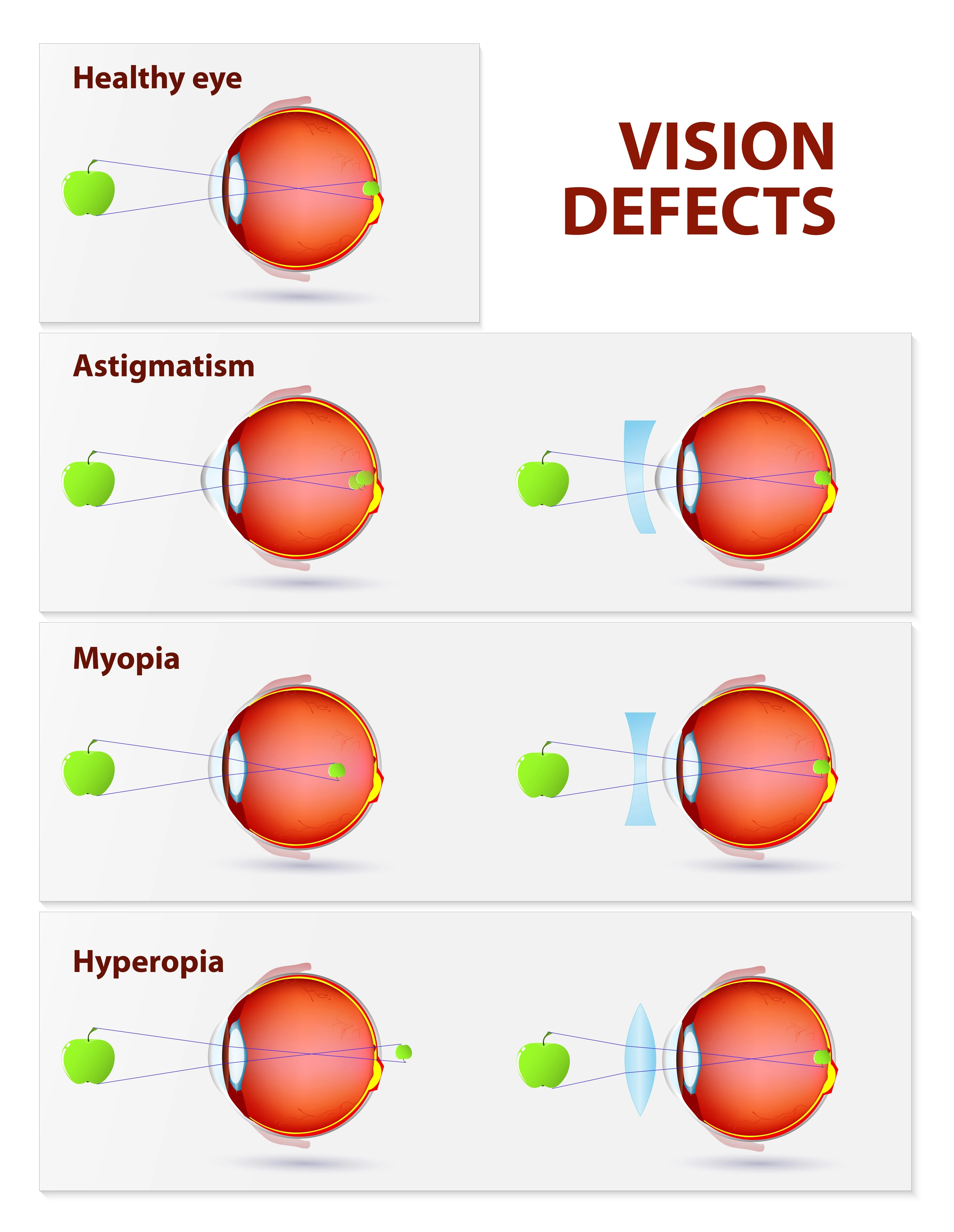 Types Of Vision Problems Refractive Surgery Corrects RSC