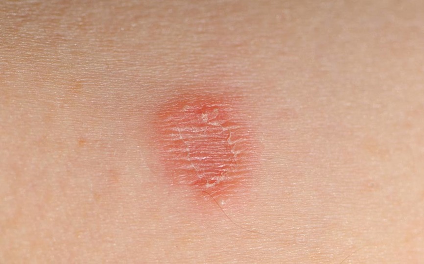 A GUIDE FOR MEMBERS TO RECOGNIZE, PREVENT, AND TREAT RINGWORM & STAPH