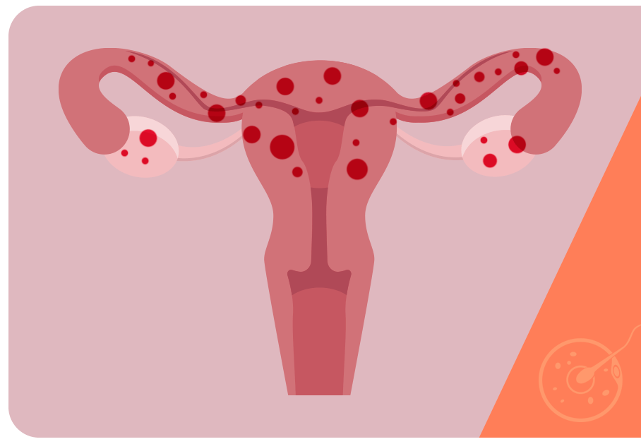 O que é endometriose e como ela pode afetar a fertilidade
