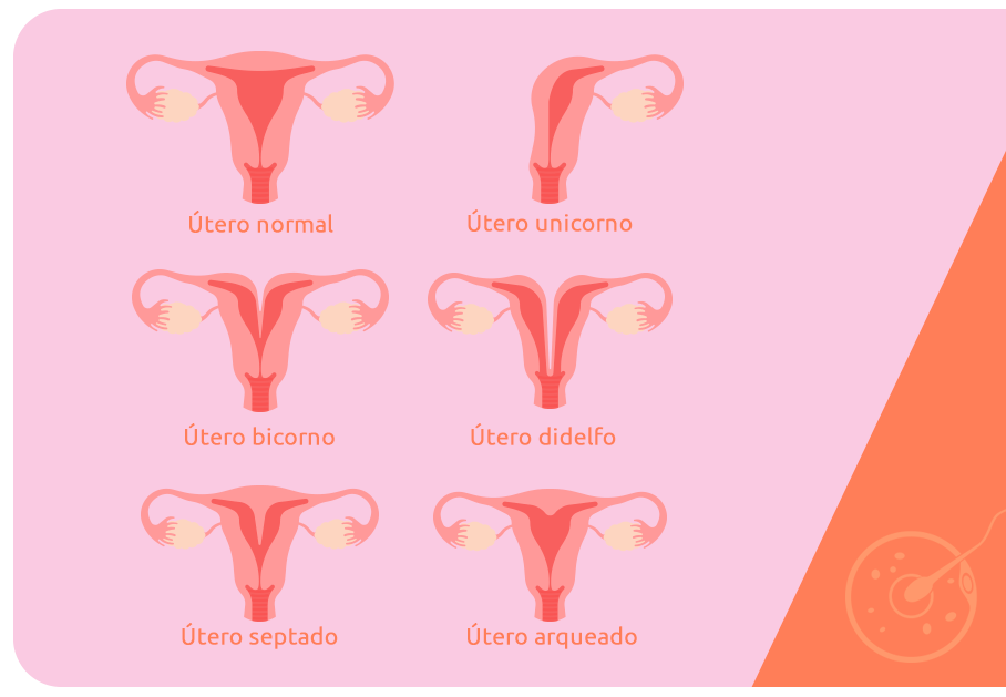 Malformações uterinas e infertilidade feminina Art Fértil