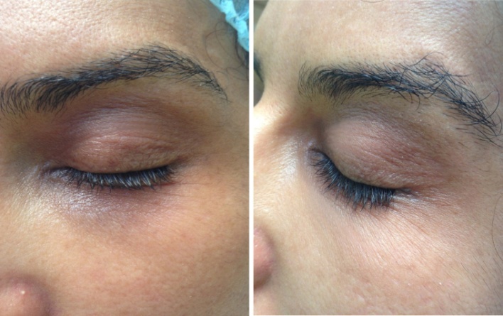 Treatment of Periorbital Hyperpigmentation Using PlateletRich Plasma
