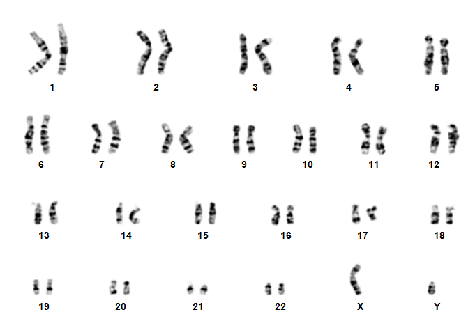 Robertsonian translocation (rob) is a chromosomal abnormality wherein a certain type of a chromosome becomes attached to another. Robertsonian Translocation Down Syndrome : Robertsonian Translocation in a Down Syndrome: A Case Report