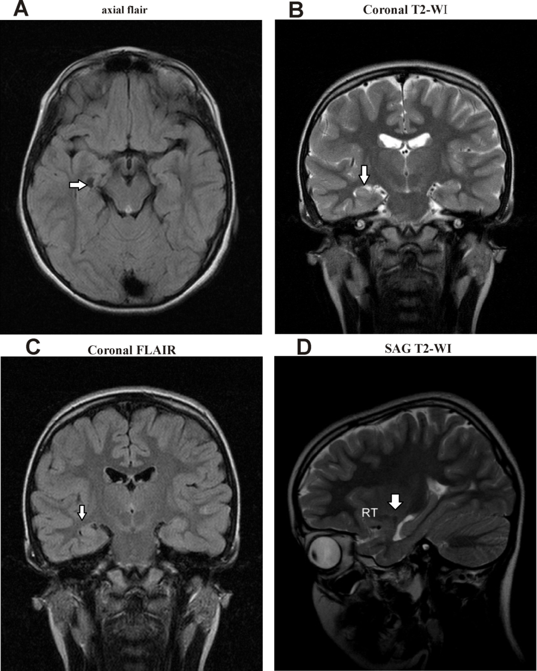 Mri hippocampus anatomy xaserandroid