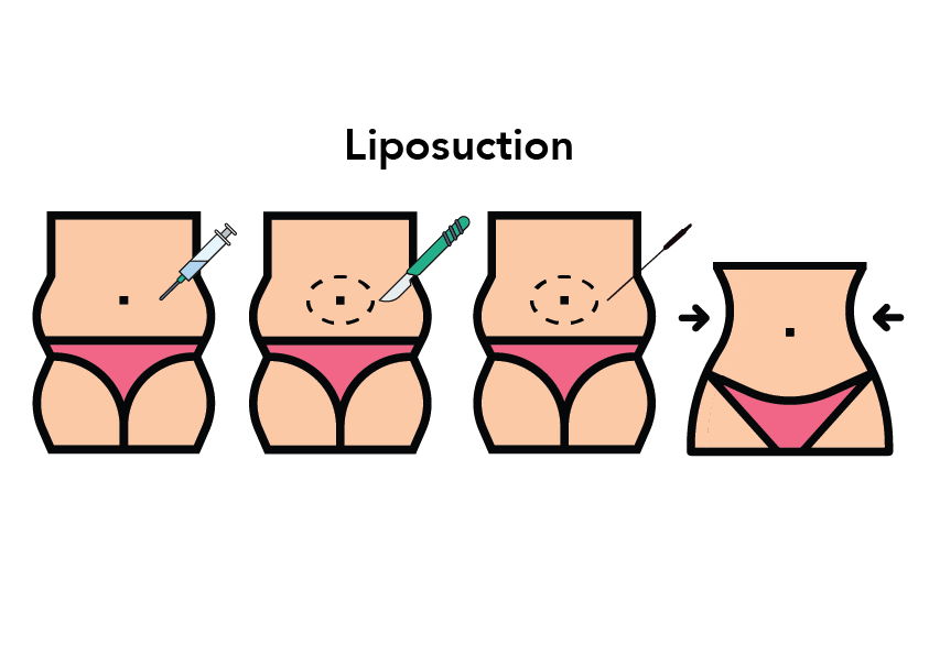 Difference between Tummy Tuck and Liposuction MyMediTravel Knowledge