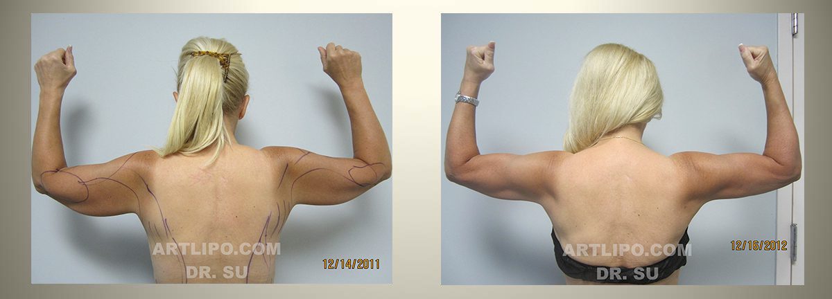 Skin Tightening Liposuction Tampa Skin Removal Florida