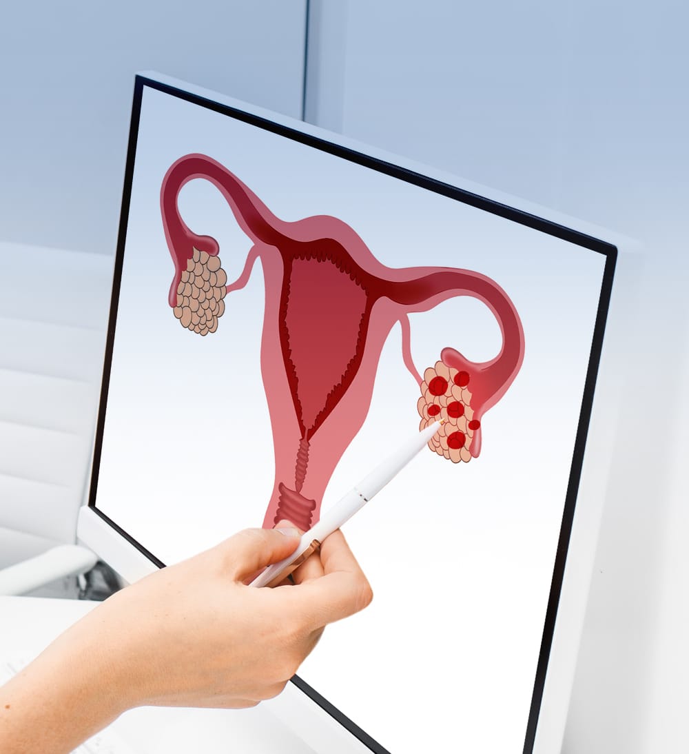 Endometriomas conheça os sintomas Clínica Art Medicina