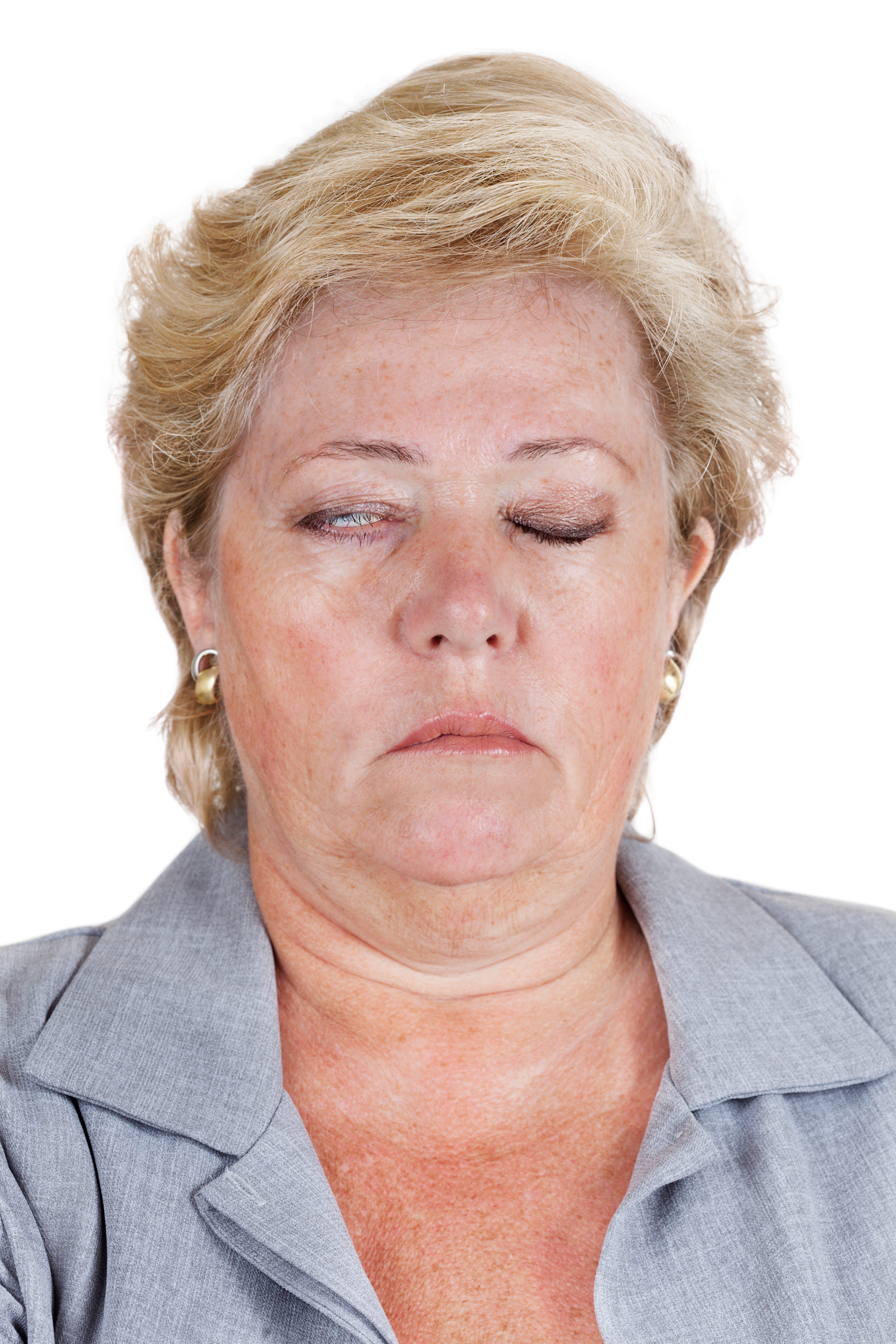 Bell's Palsy one eye won't close completely Art of