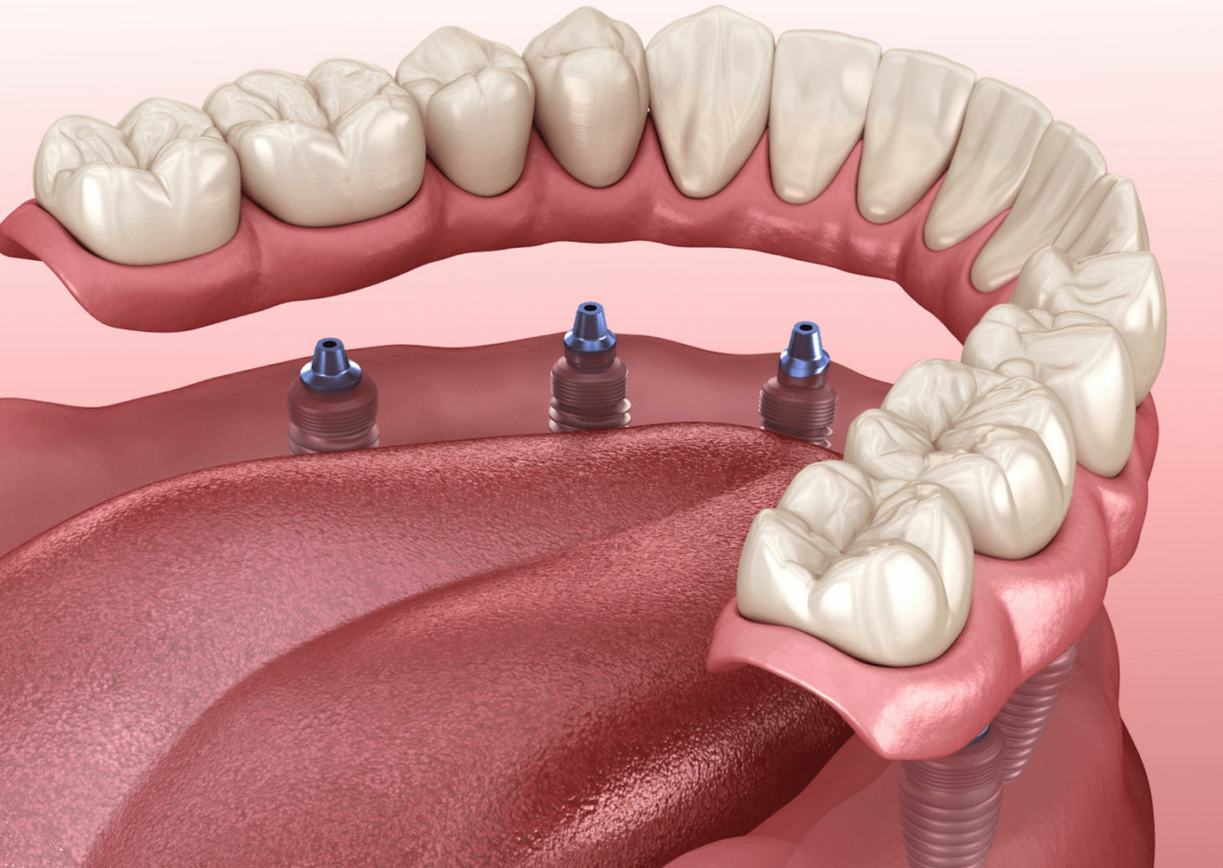 All On 4 Dental Implants Gold Coast Costs, Options & FAQs