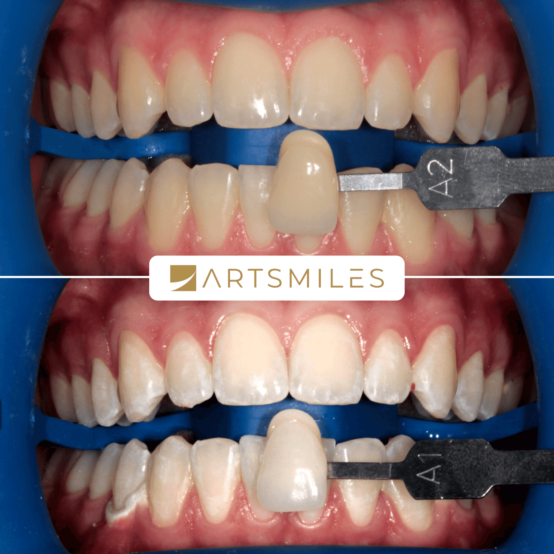 Teeth Whitening Gold Coast Teeth Whitening Dentist