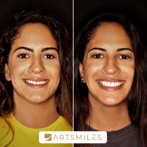 Composite Veneers Gold Coast Costs, Options & FAQs