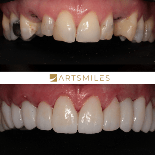 Cost Of Veneers In 2023 Veneers Prices And Payment Plans