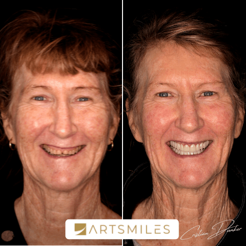 Cost Of Veneers In 2023 Veneers Prices And Payment Plans