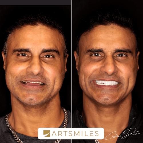 Cost Of Veneers In 2023 Veneers Prices And Payment Plans