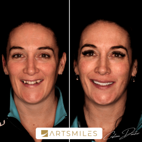 Cost Of Veneers In 2023 Veneers Prices And Payment Plans