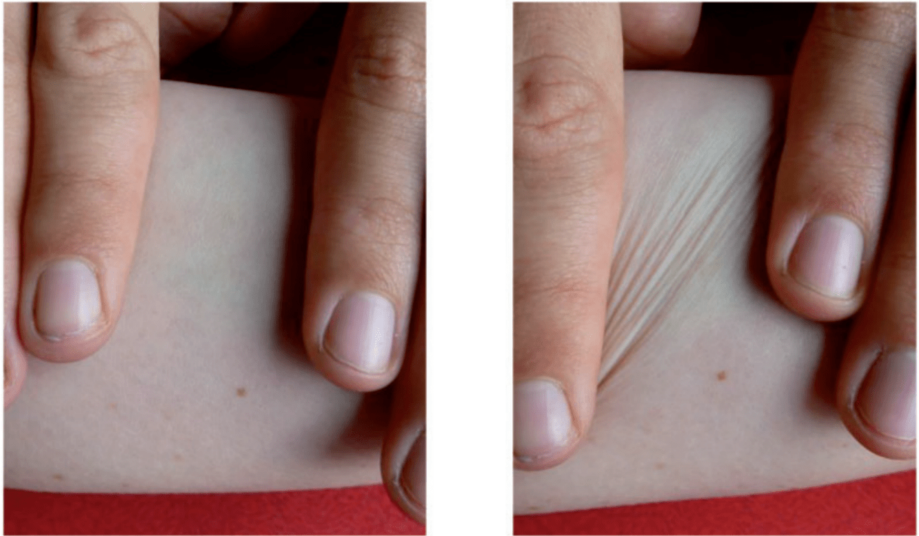 Shear instability in skin tissue Artur L Gower