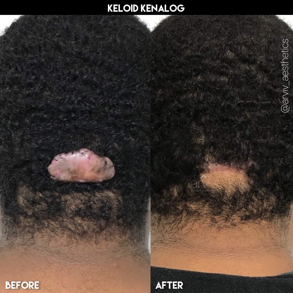 Miami Keloid Removal & Treatment Arviv Medical Aesthetics