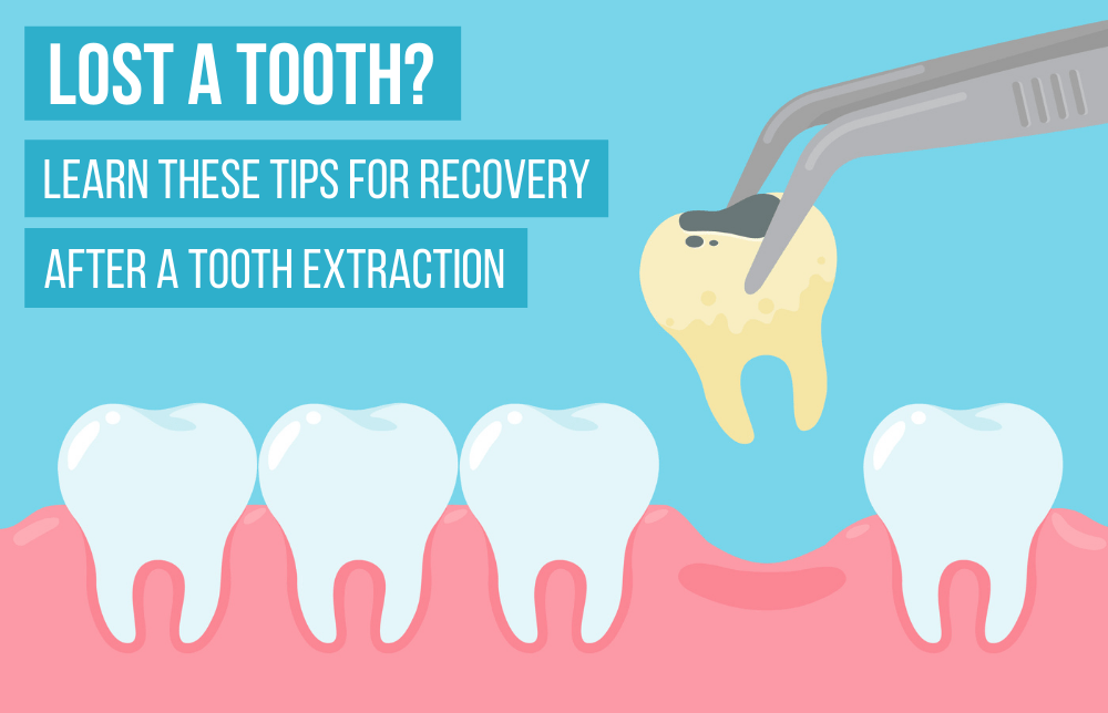 Lost A Tooth? Learn These Tips For Recovery After A Tooth Extraction