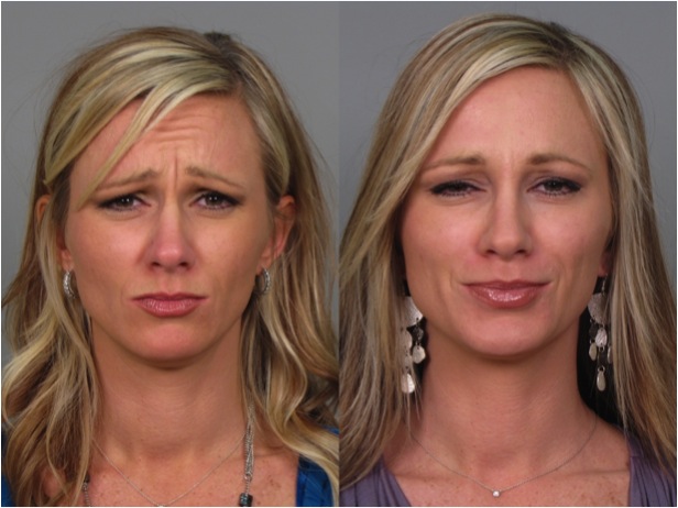 Botox Before After Photo Gallery Atlanta Roswell GA
