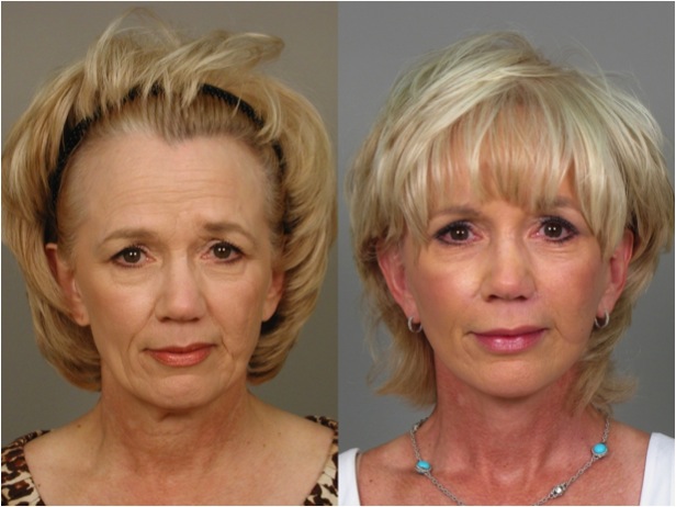 Botox Before After Photo Gallery Atlanta Roswell GA