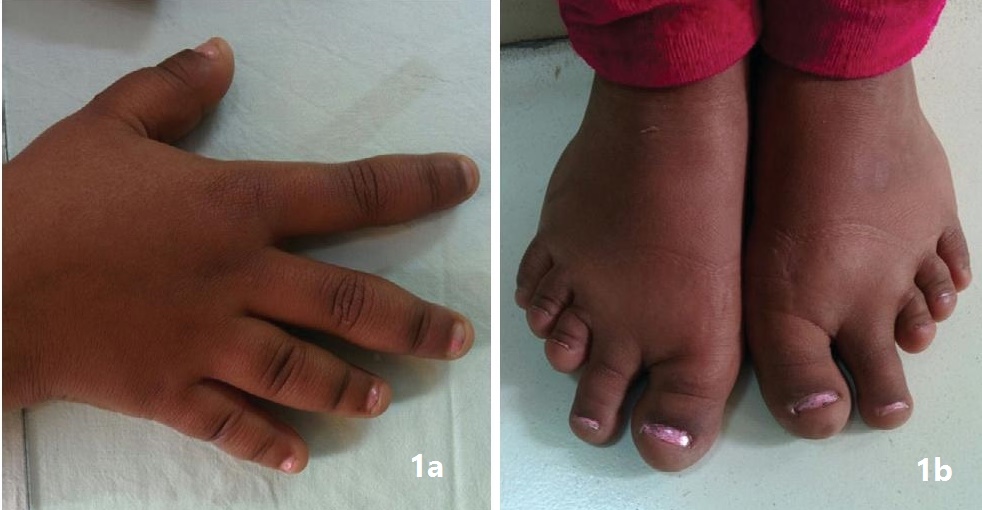 Turner Syndrome with Pseudohypoparathyroidism A Case Report Syed