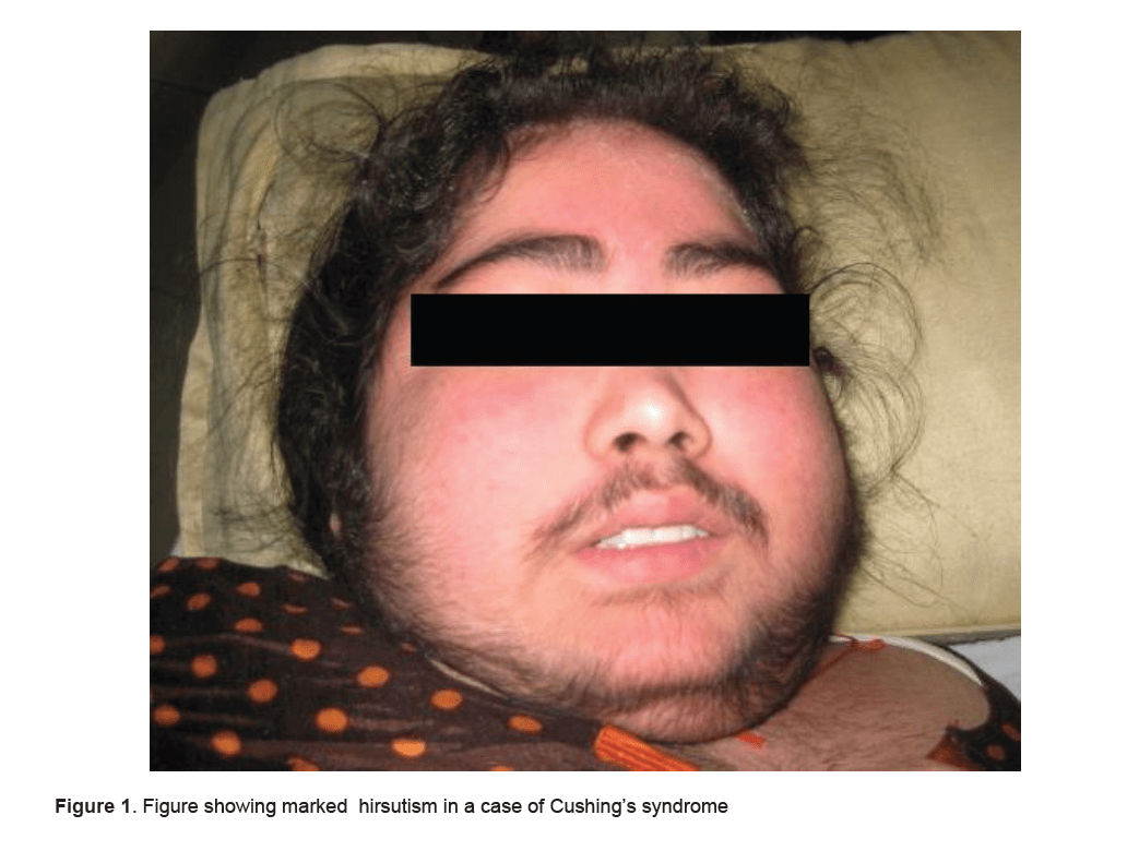 A Bearded Indian Female A Rare Presentation of Cushing's Syndrome