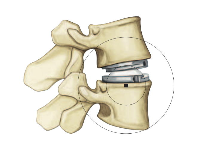 Lumbar Disc Replacement FAQs Spine Doctor Articles Asia Medical
