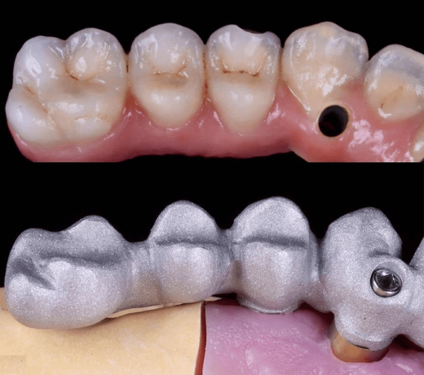 İmplant Üstü Metal Seramik Asistanbul Dent Dijital Diş Laboratuvarı