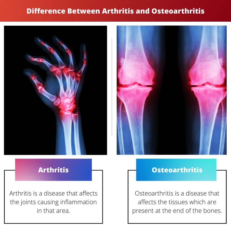 Arthritis vs Osteoarthritis Difference and Comparison