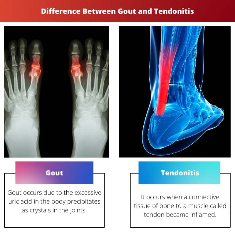 Gout vs Tendonitis Difference and Comparison