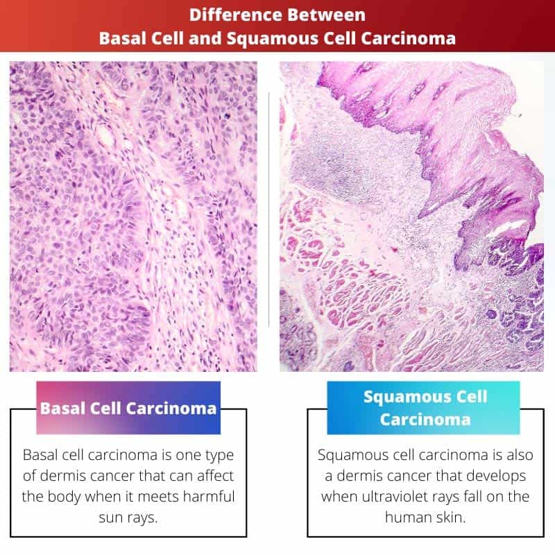 Basal Cell Versus Squamous Cell