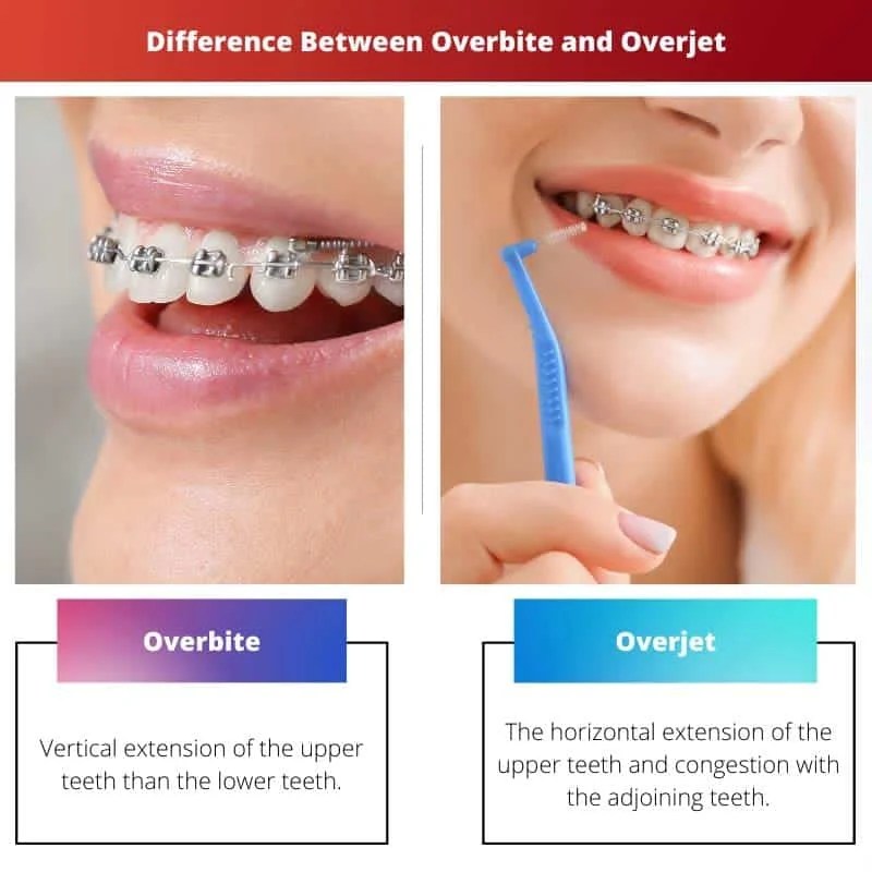 Overbite vs Overjet Difference and Comparison