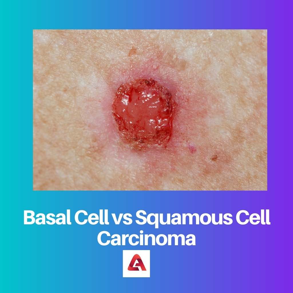 Basal Cell vs Squamous Cell Carcinoma Difference and Comparison