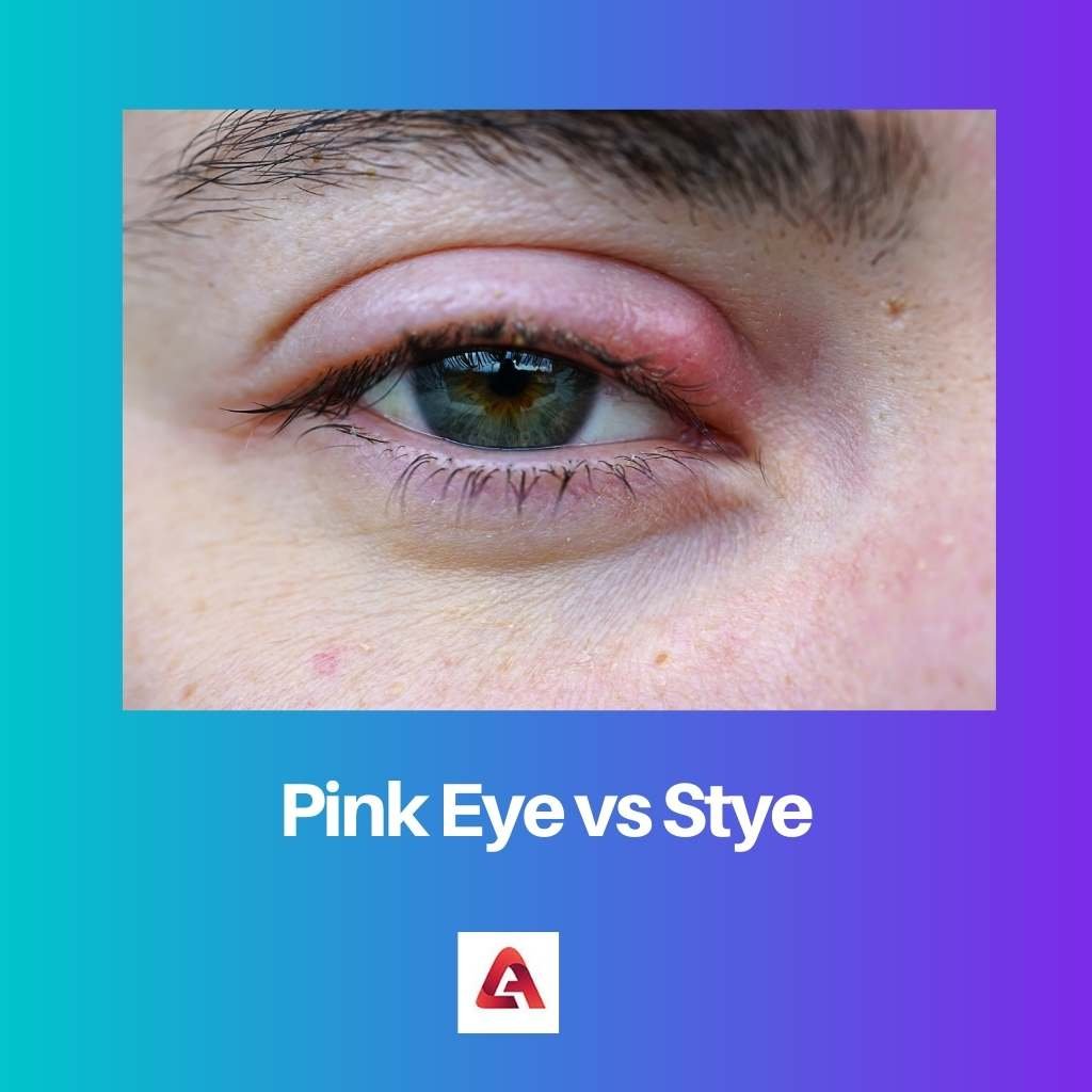 Pink Eye vs Stye Difference and Comparison