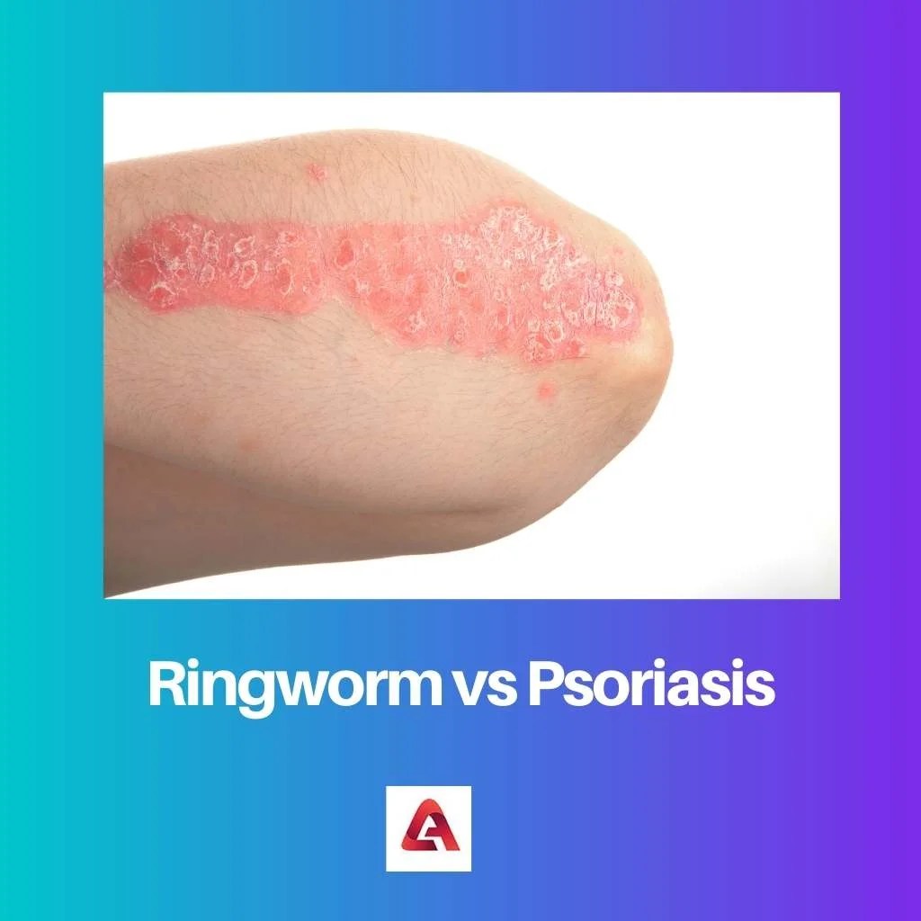 Ringworm vs Psoriasis Difference and Comparison