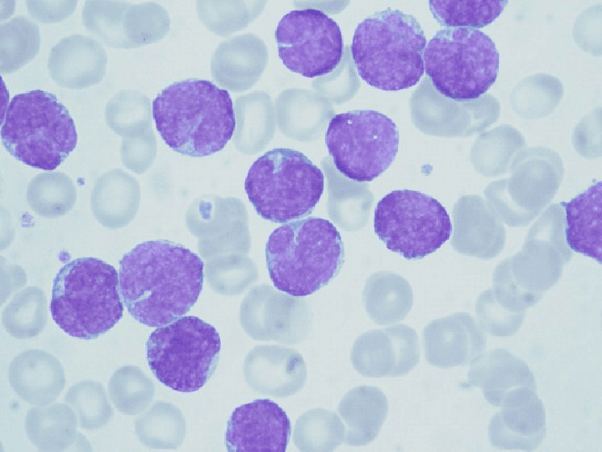 Approach to Lymphocytosis Ask Hematologist Understand Hematology