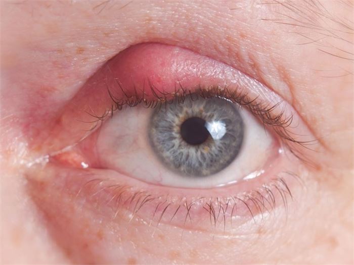 Are Styes Contagious? All Time Popular Articles