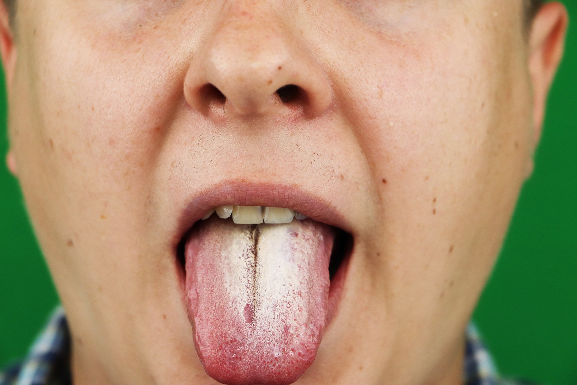 Oral Thrush Home Remedies, Causes, Symptoms & More Ask the Dentist