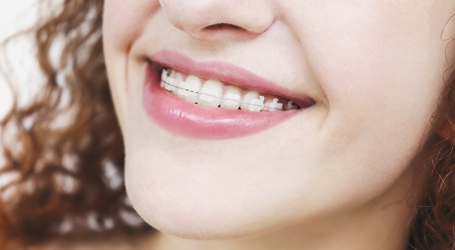 Ceramic Braces vs. Metal Braces [Plus Costs & FAQs] Ask the Dentist