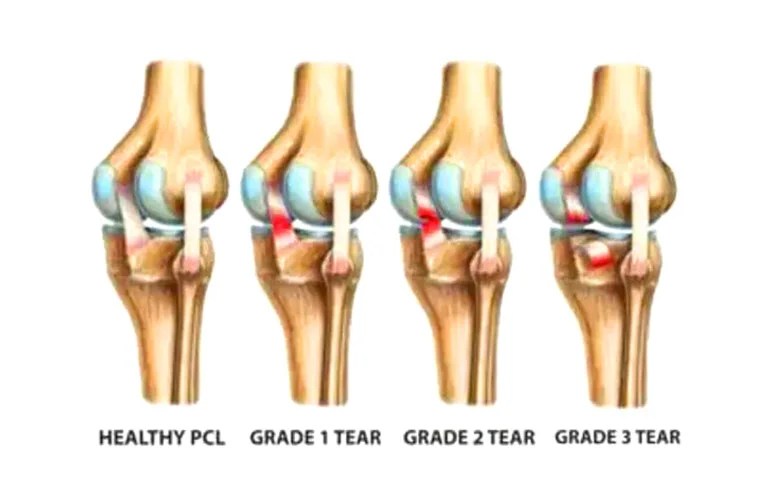 "PCL Injury" All You Need To Know