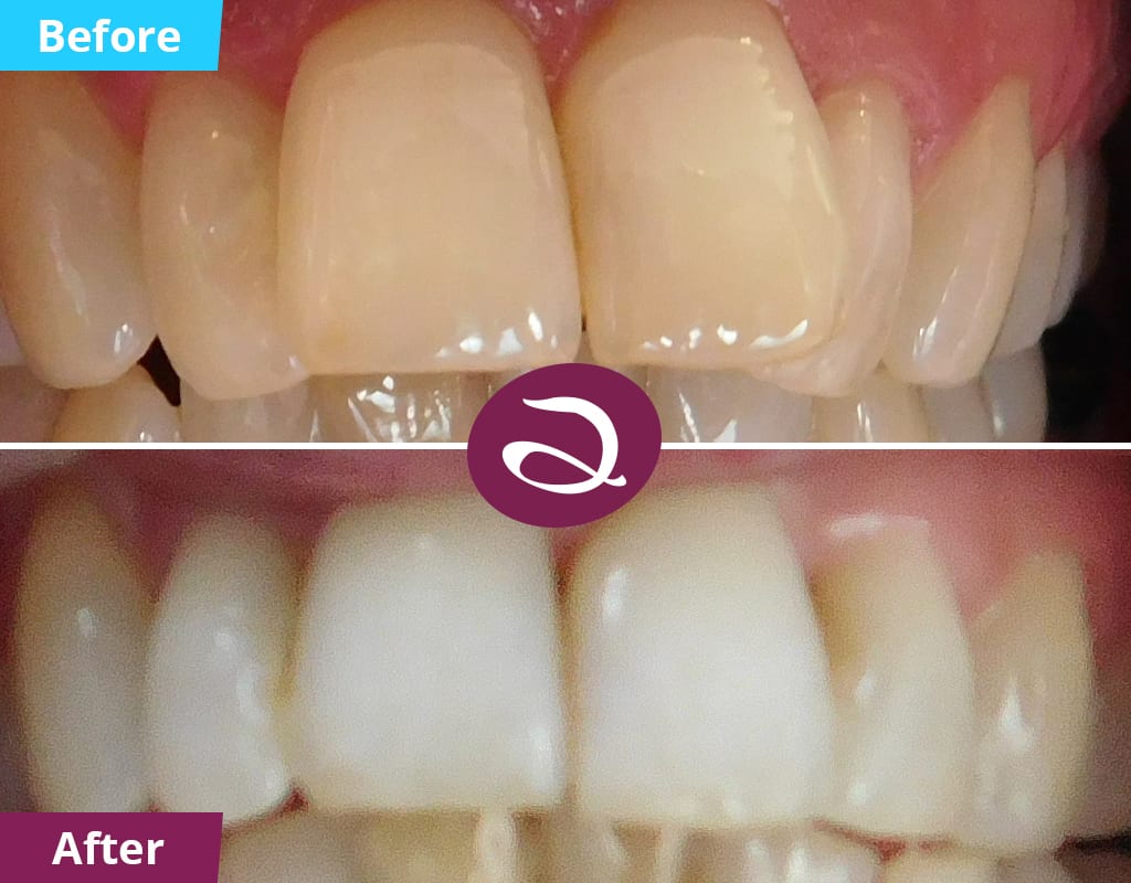 Upper Ceramic B Aspects Dental & Referral Milton Keynes