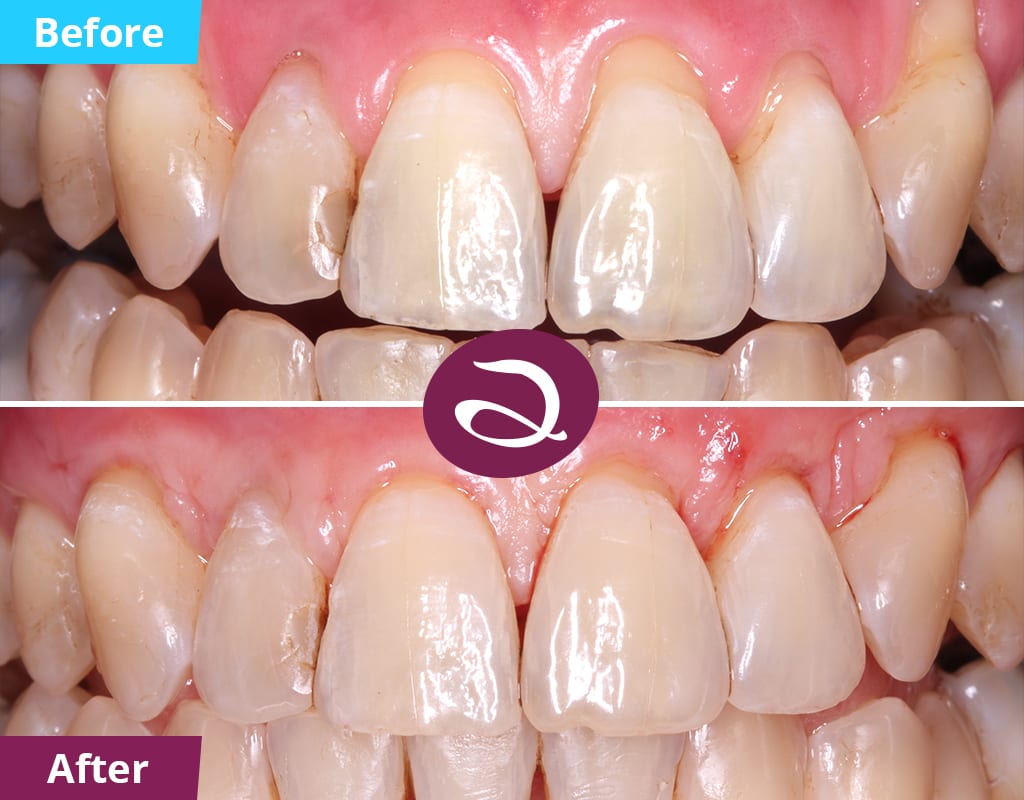 Periodontal surgery to correct receding gums Aspects